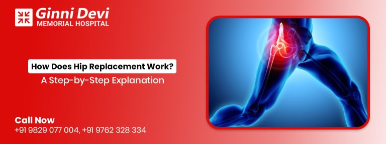 How Does Hip Replacement Work? A Step-by-Step Explanation