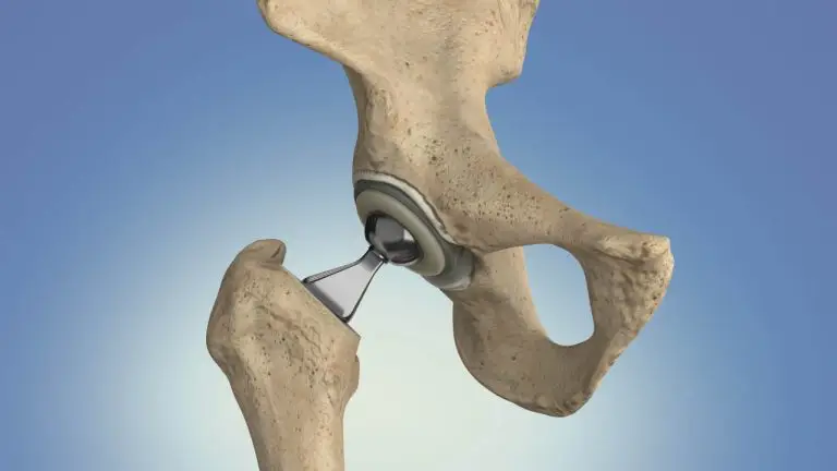 hip-replacement