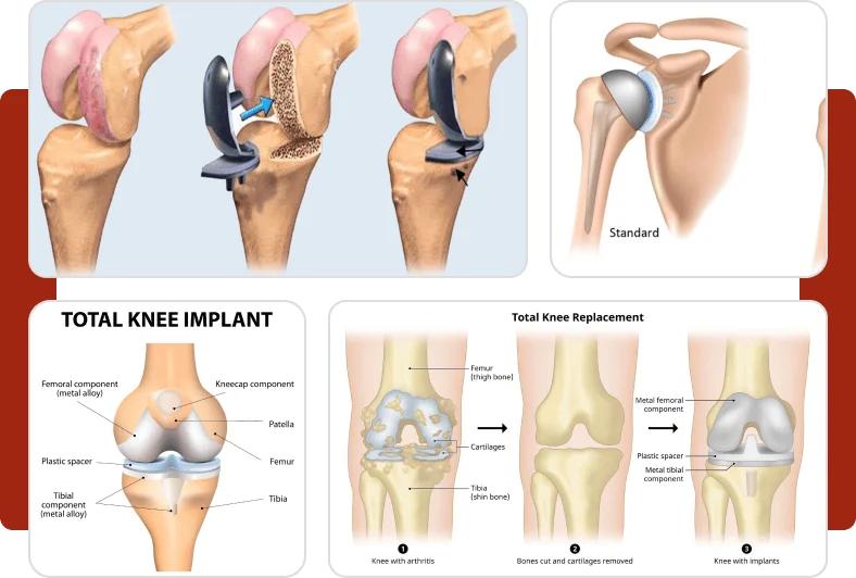 Types of hip Replacement Surgeries