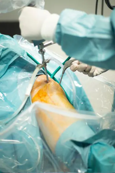 Knee Arthroscopy Surgery