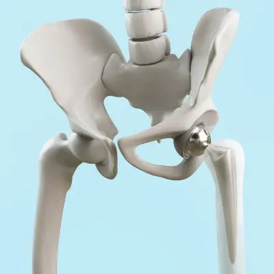 Hip replacement surgery skeleton