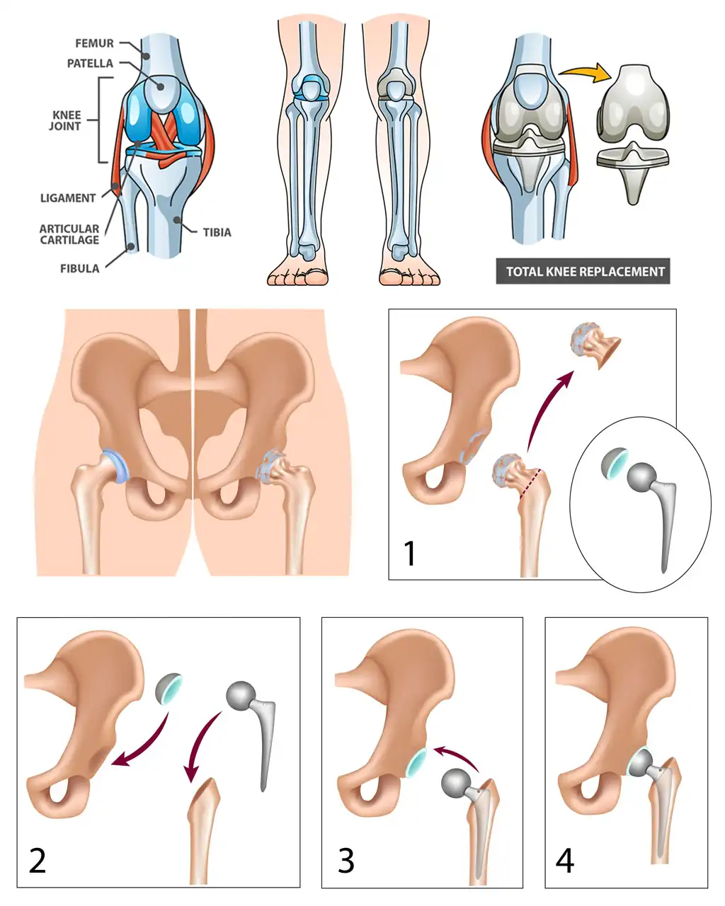 I-Align technique for knee and hip replacement