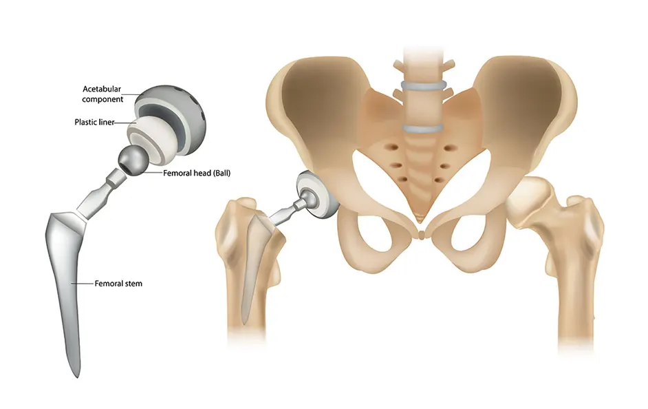 total-hip-replacement-with-i-align-technique