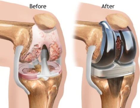 total Knee replacement surgery with I-align technique