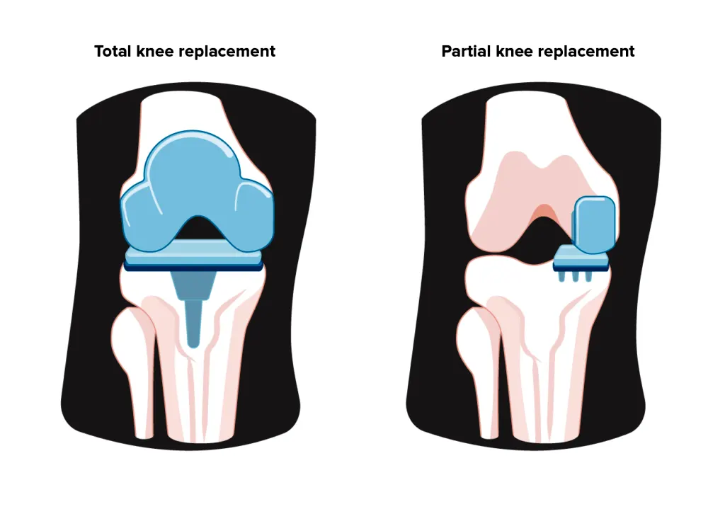 types of knee replacement surgery