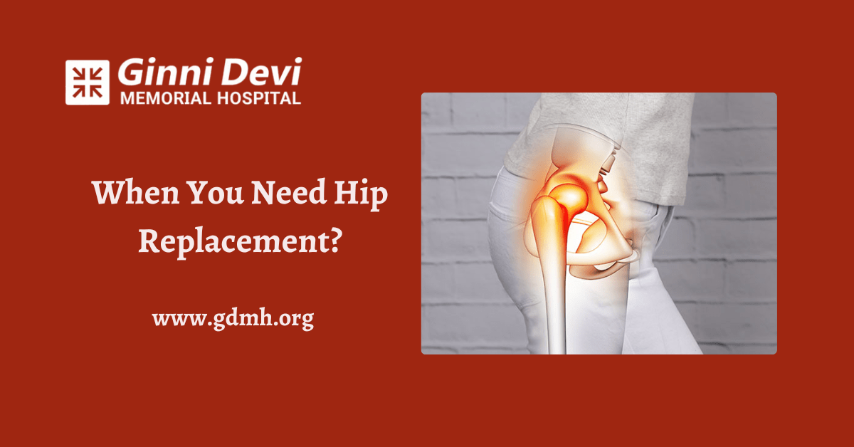 When You Need Hip Replacement