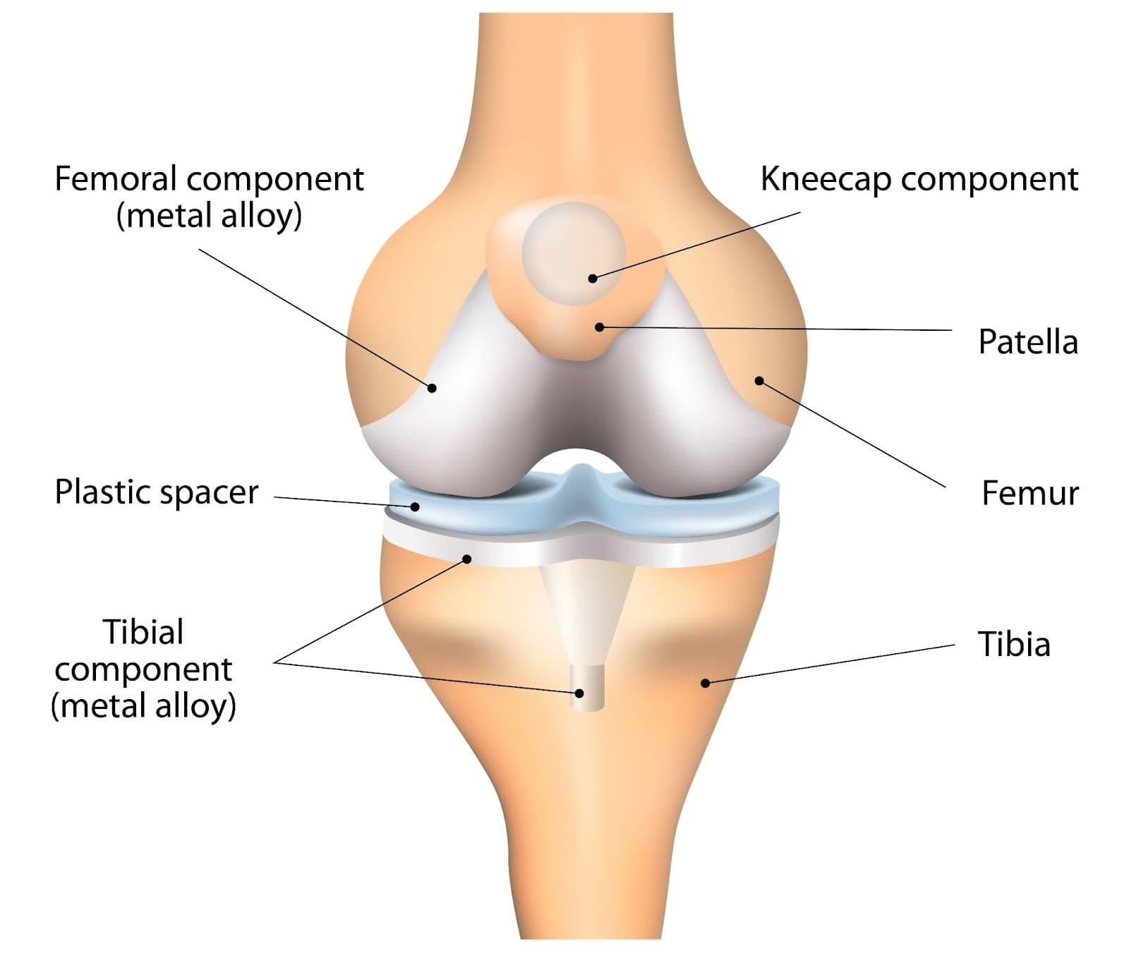 joint-replacement-overview