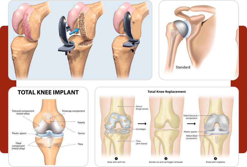 joint-replacement